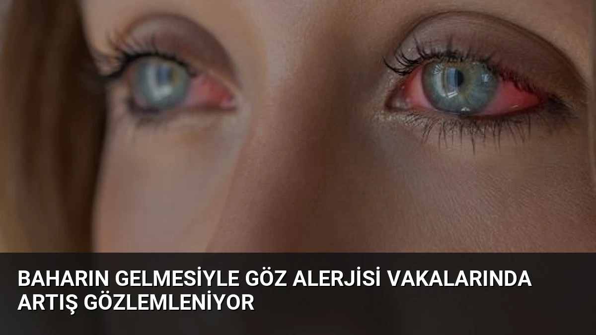 Baharın Gelmesiyle Göz Alerjisi Vakalarında Artış Gözlemleniyor